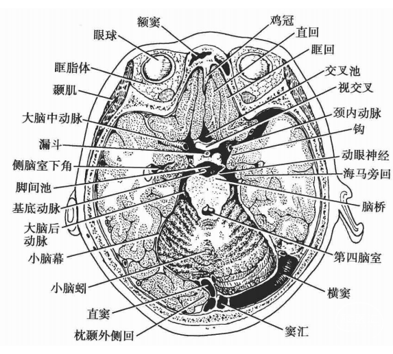 图-5经视交叉横断层面在经窦汇以下的横断层面上,小脑幕呈m形(即双峰