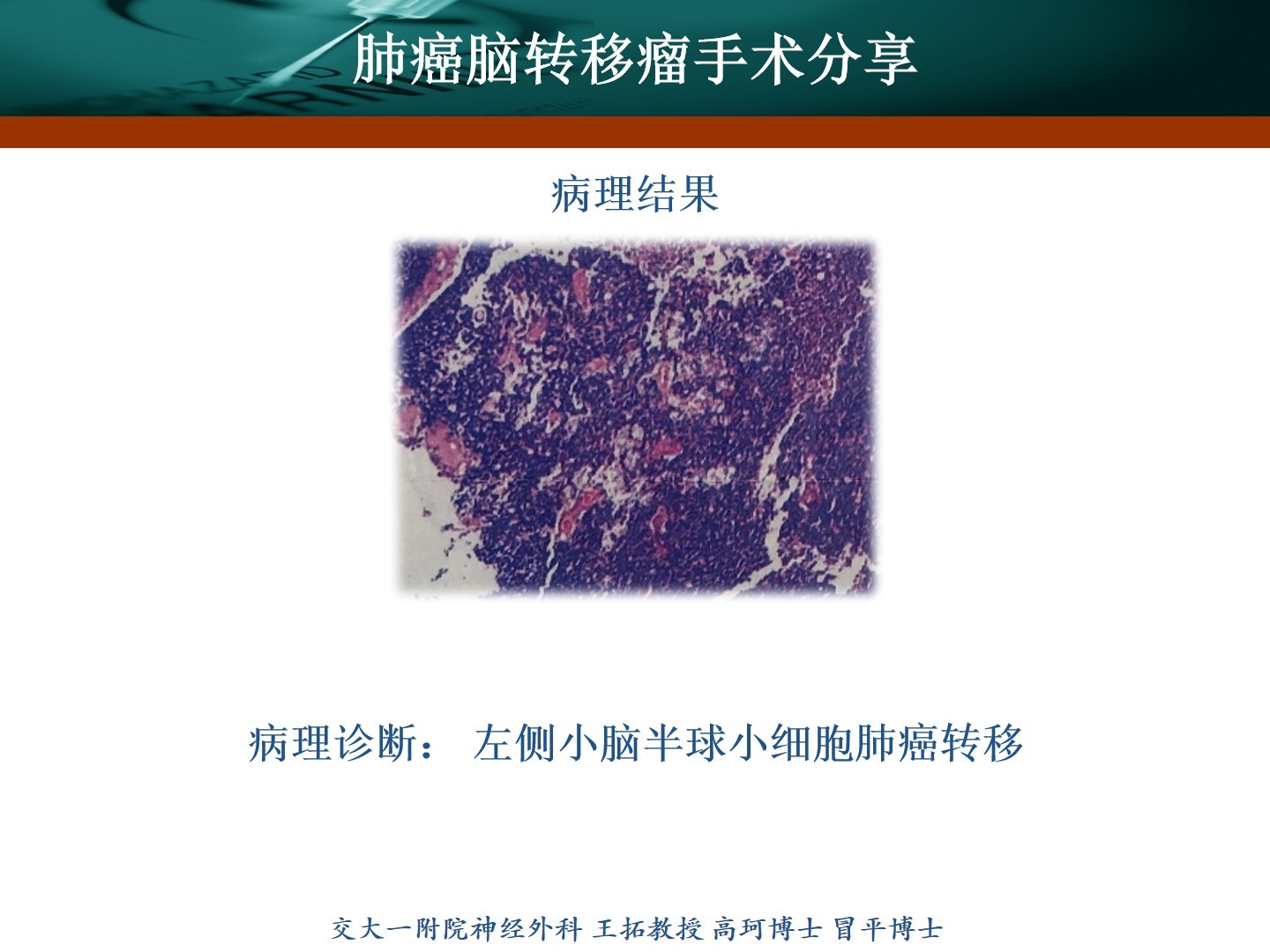 西安交通大学第一附属医院王拓教授团队肺癌脑转移瘤手术分享
