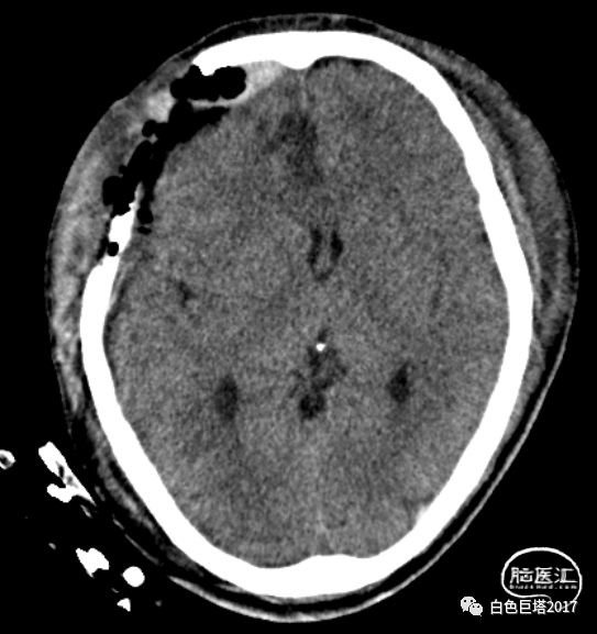 瞳孔术后左:右为2mm:3mm,光反射消失.