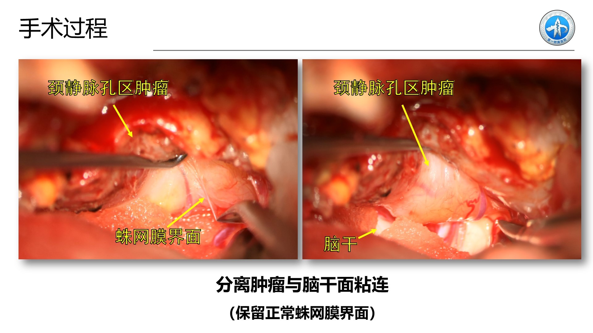 西安交通大学第一附属医院王拓教授团队:一例颈静脉孔