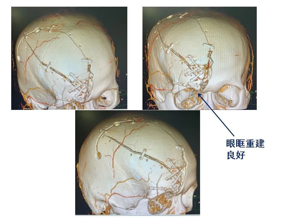 监测有道丨开放性颅脑外伤伴前额部粉碎性骨折一例报道——颅脑创伤