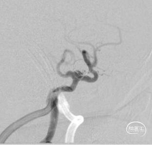 神外之声颈内动脉永存三叉动脉动脉瘤介入治疗1例