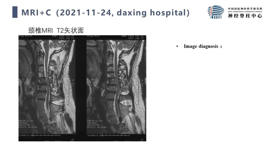 段婉茹副主任医师脊髓栓系的治疗