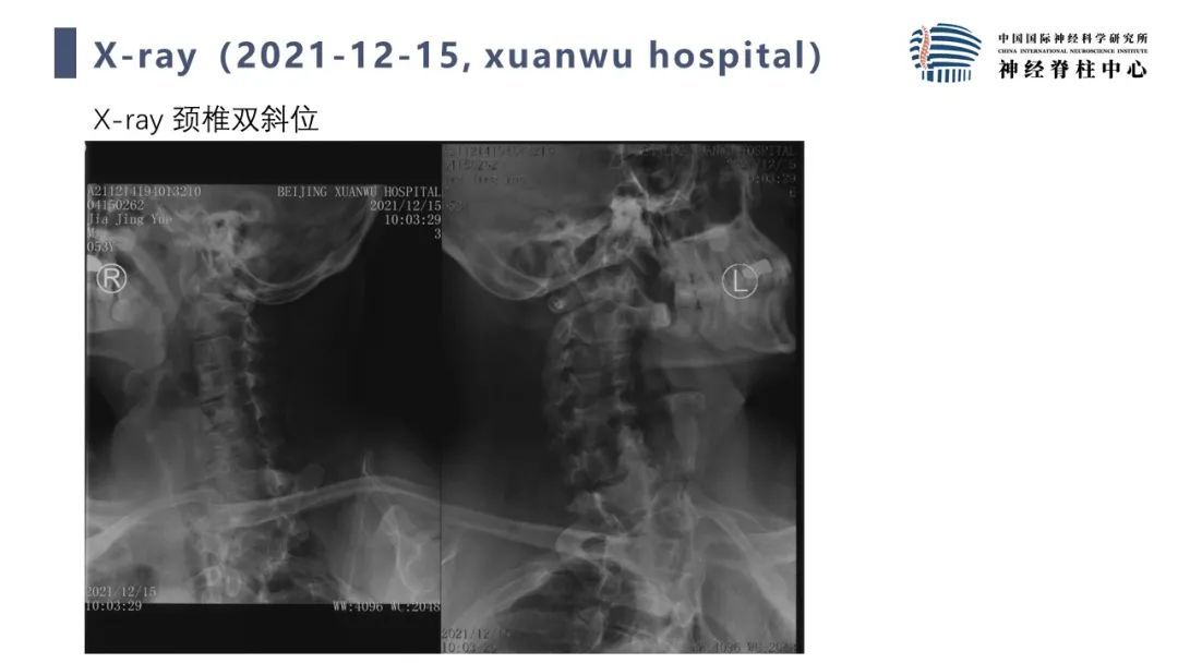 段婉茹副主任医师脊髓栓系的治疗