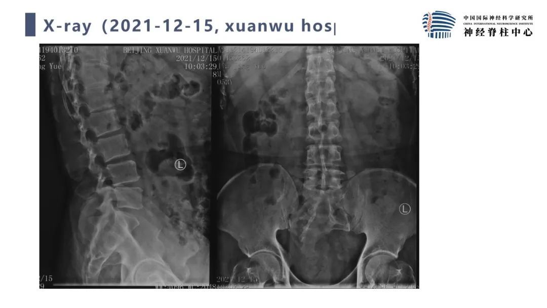 段婉茹副主任医师脊髓栓系的治疗