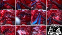 昆明三博2024：前颅窝底硬膜动静脉瘘切除术及血肿清除术