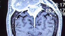 巨大窦旁-板障脑膜瘤切除