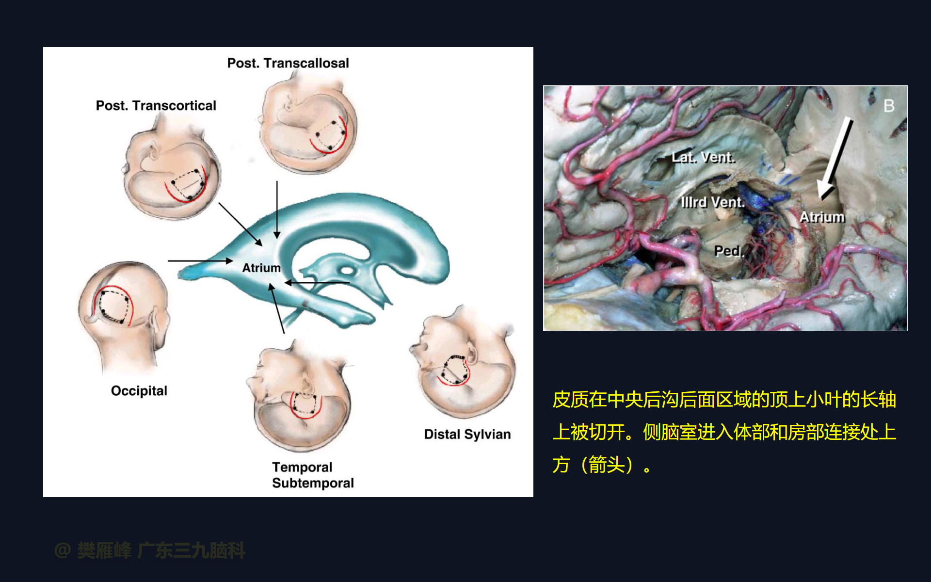 手术系列069:经皮层入路切除侧脑室三角区非典型脉络膜乳头状瘤 - 脑医汇