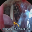 内镜下AICA移位三叉神经痛MVD术 