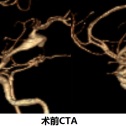 翼点入路左侧大脑中大型血栓型动脉瘤夹闭术分享(附视频）