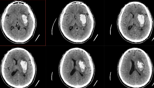 高血压脑出血的神经内镜手术治疗