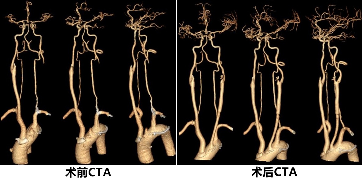 显微颈动脉开通手术病例分享(附手术视频）