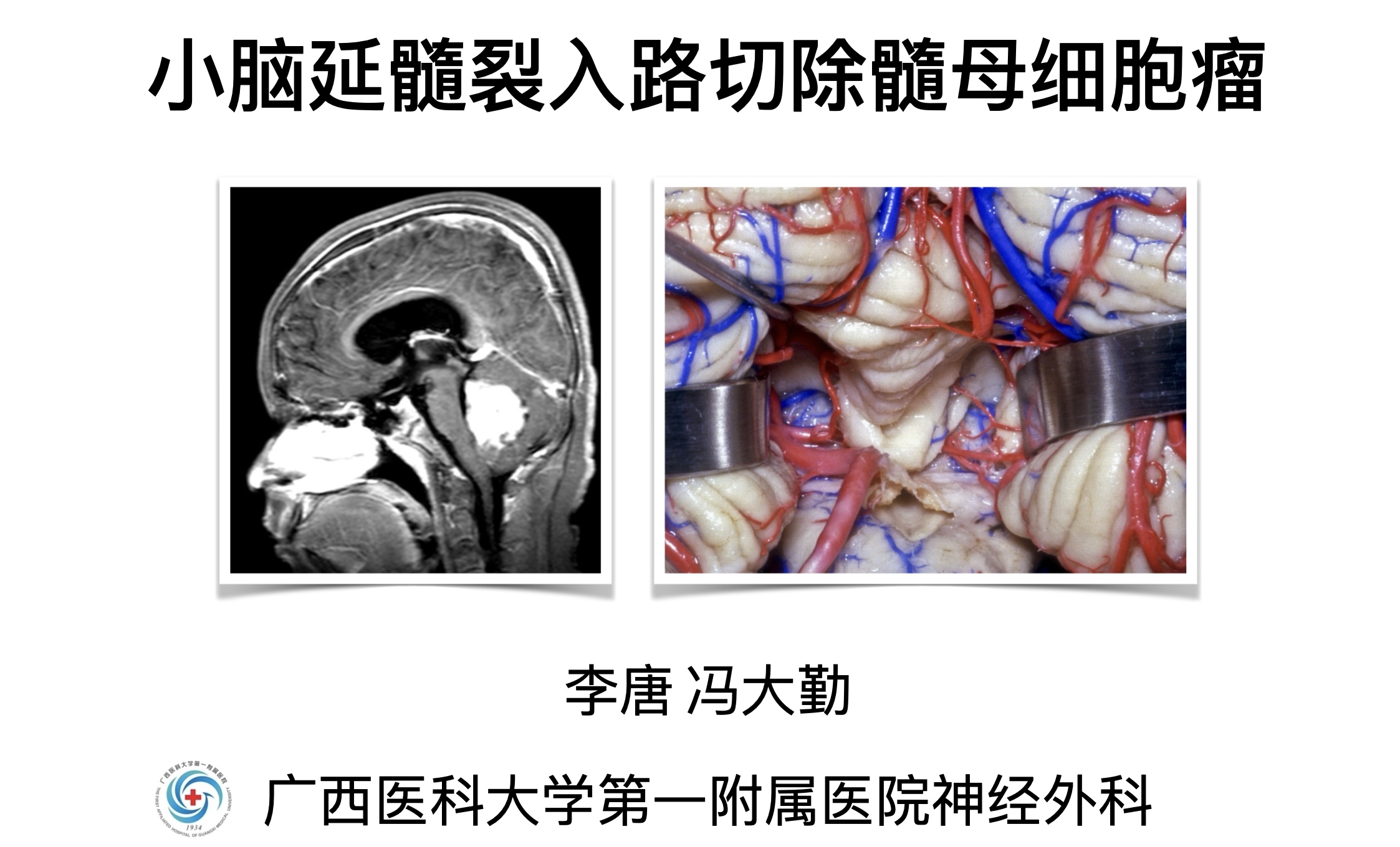 小脑延髓裂入路切除髓母细胞瘤