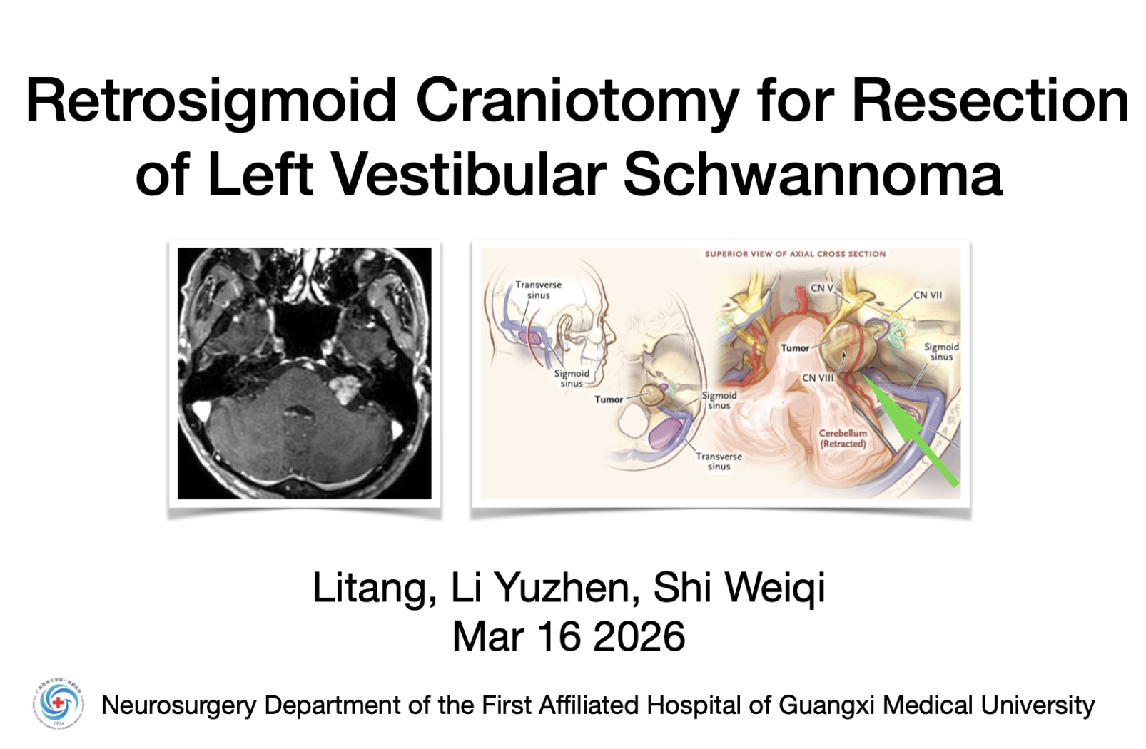 乙状窦后入路切除Koos3级听神经瘤