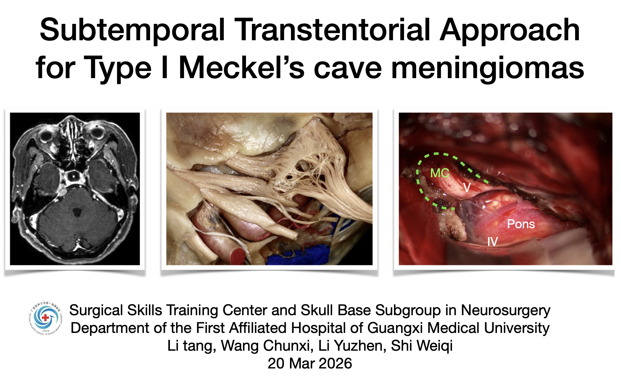 颞下经天幕入路切除Type I 型Meckel‘s cave脑膜瘤