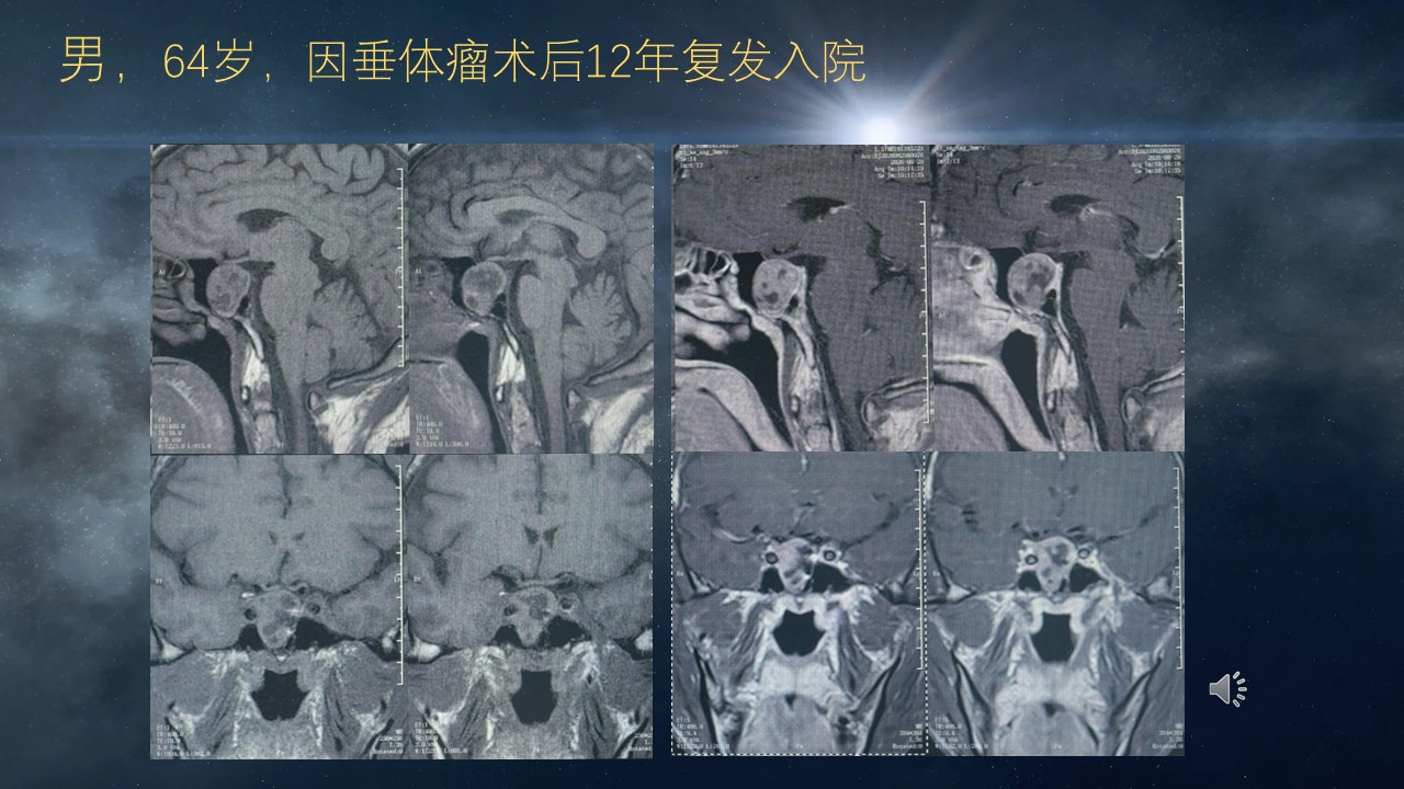 垂体瘤切除术