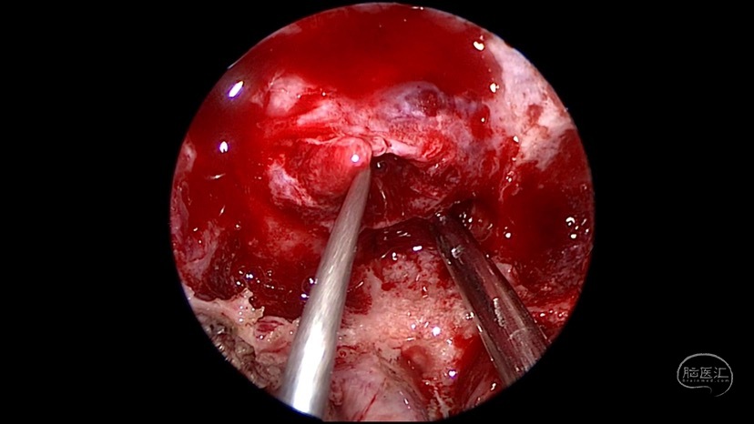 神经内镜切除侵袭海绵窦垂体瘤一例