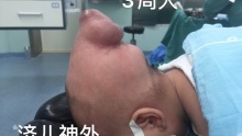 一例新生儿至幼儿期原发性脑膨出（颅裂畸形）治疗经验