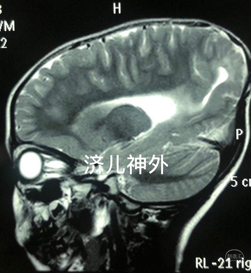 一例新生儿至幼儿期原发性脑膨出(颅裂畸形)治疗经验