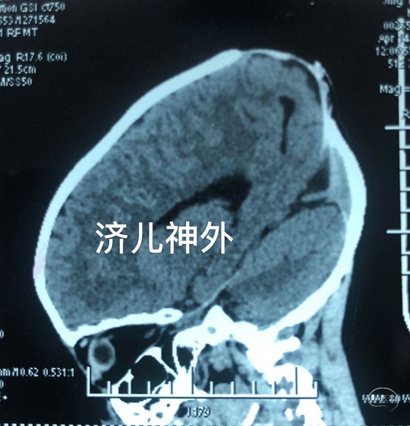 一例新生儿至幼儿期原发性脑膨出(颅裂畸形)治疗经验