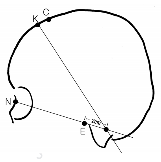 基底节血肿经额kochers点徒手穿刺技巧及几个趣味的视觉试验