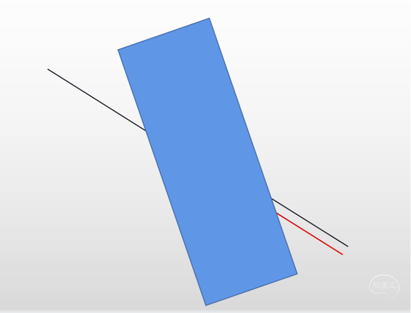 基底节血肿经额kochers点徒手穿刺技巧及几个趣味的视觉试验