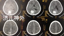 一例9岁女童非外伤自发性脑出血，一期手术清除血肿及畸形血管团的诊疗经验。