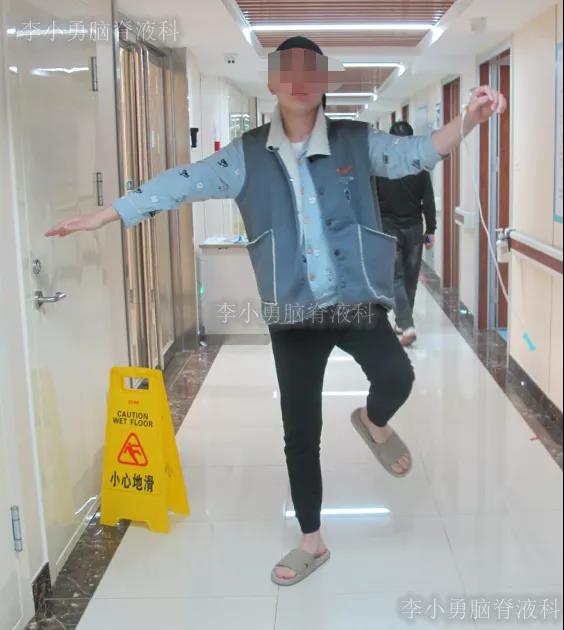 脑血管畸形出血术后3次脑室引流术，腰大池引流术反复腰穿置管引流致颅内感染脑室粘连，经李小勇脑脊科治好