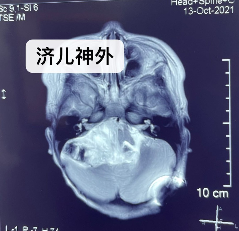 1岁9月CPA区巨大室管膜瘤手术一例