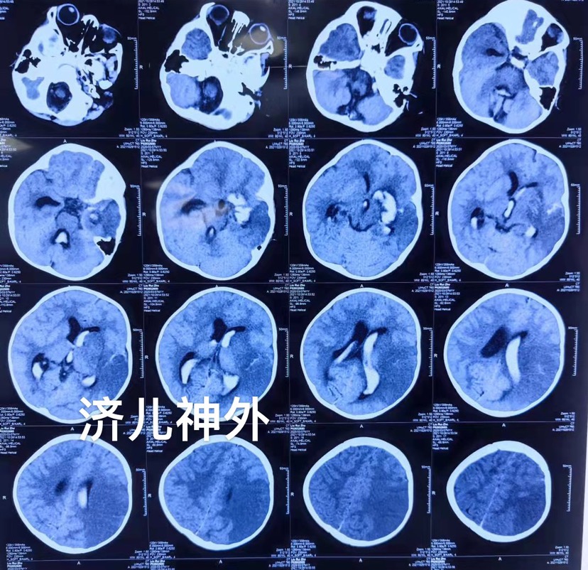幼儿大脑中动脉动脉瘤合并出血综合治疗一例