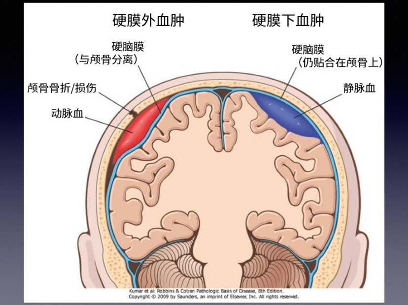 图解硬膜外血肿(2013课件)