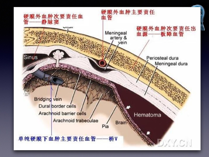 硬脑膜外血肿解剖图片