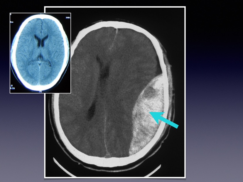 图解硬膜外血肿(2013课件)