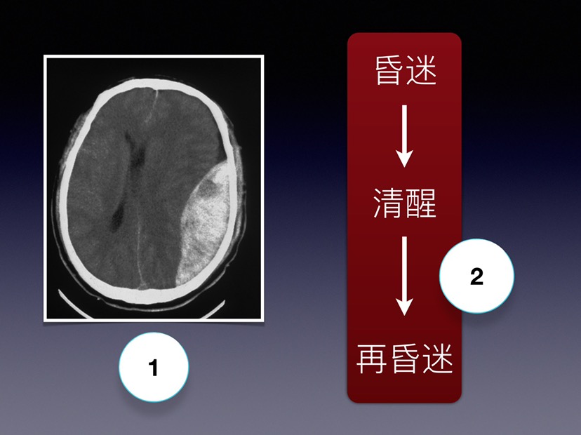 圖解硬膜外血腫(2013課件)