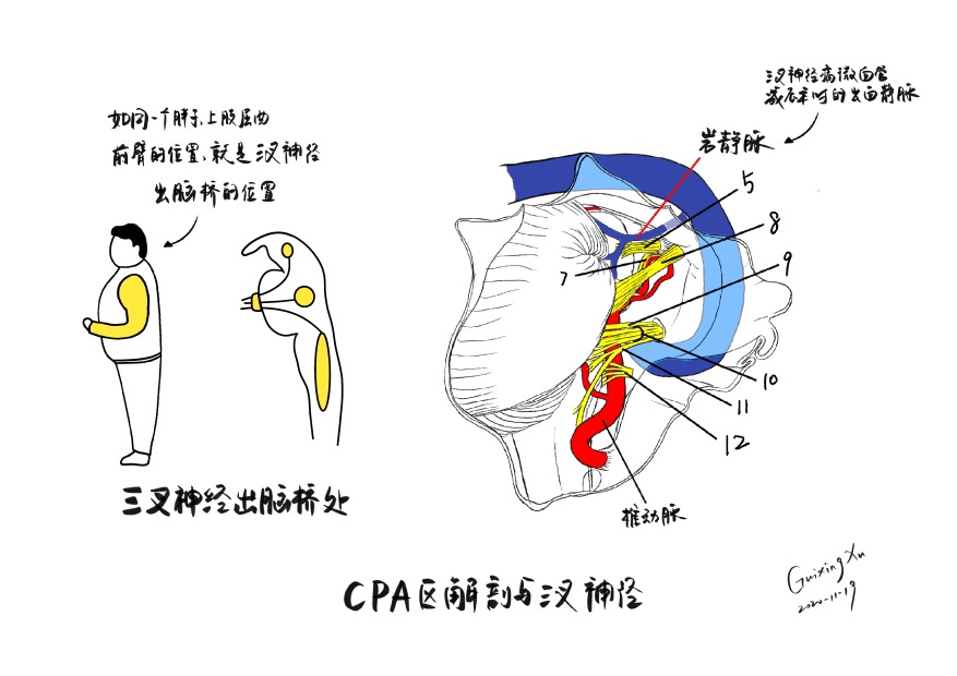 神外术中的几个keypoint(手绘) - 脑医汇 - 神外资讯 - 神介资讯