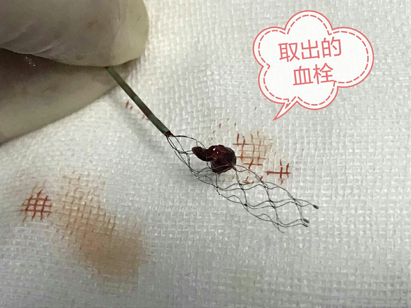 生死时速,急诊取栓成功青海省交通医院神经内科介入团队成功治疗基底