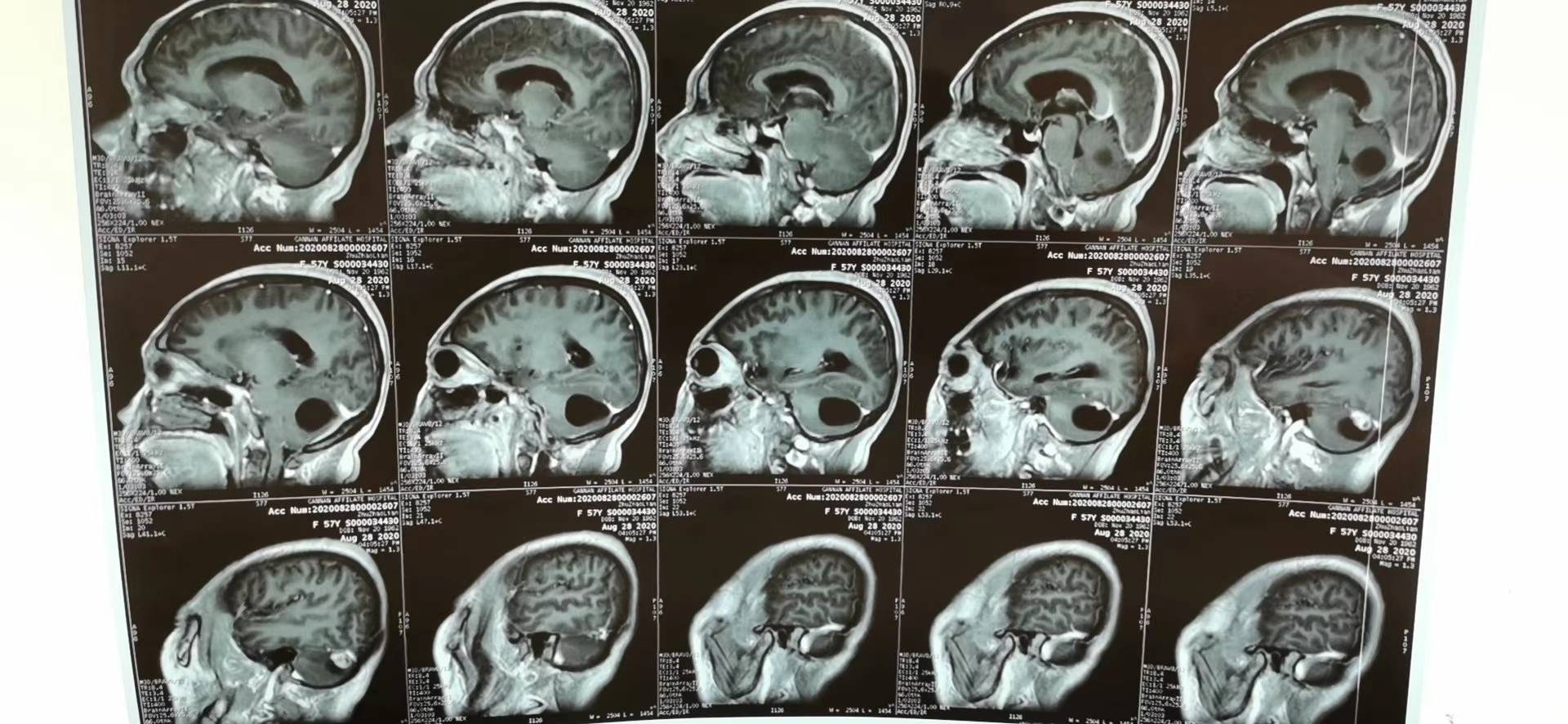 双"镜"切除脑肿瘤—记瑞金市首例内镜辅助下小脑肿瘤切除手术