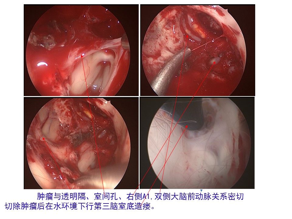 神经内镜endoport经右额中回入路切除侧脑室,室间孔室管膜下巨细胞