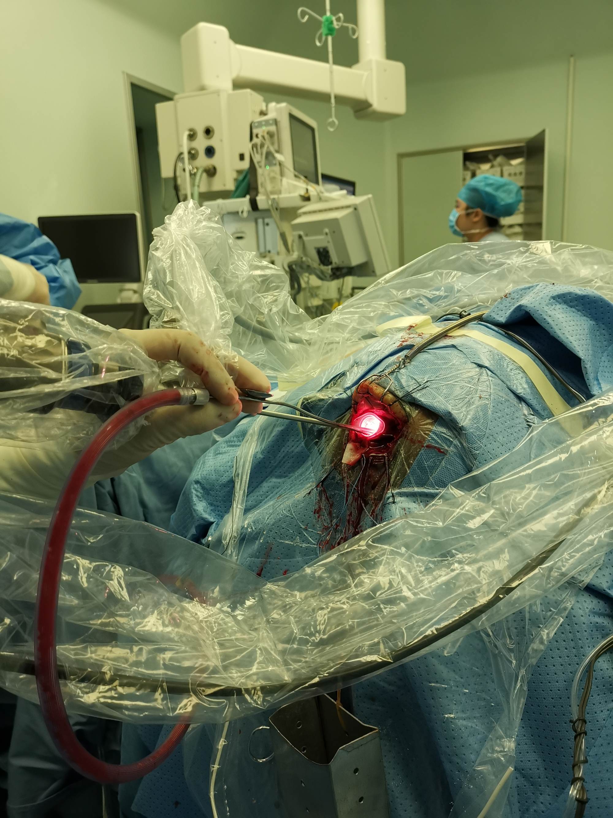 神经内镜下采用"筷子技术"清除脑内血肿