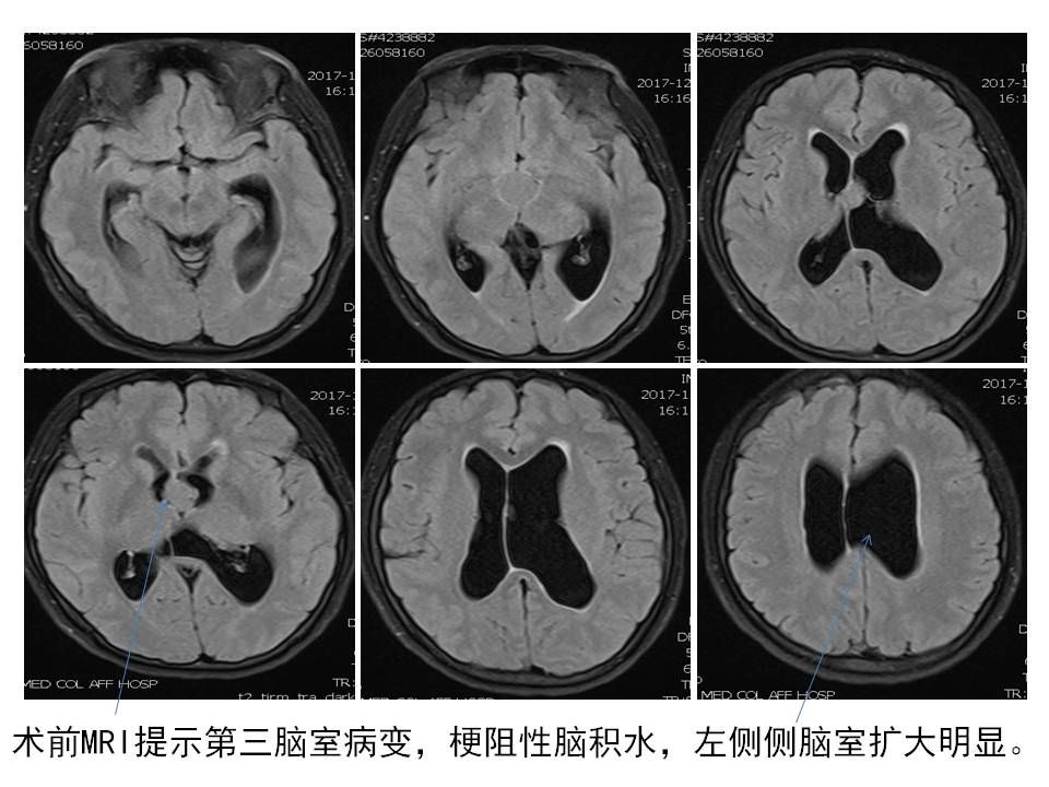 神经导航辅助神经内镜endoport技术切除第三脑室病变合并梗阻性脑积水