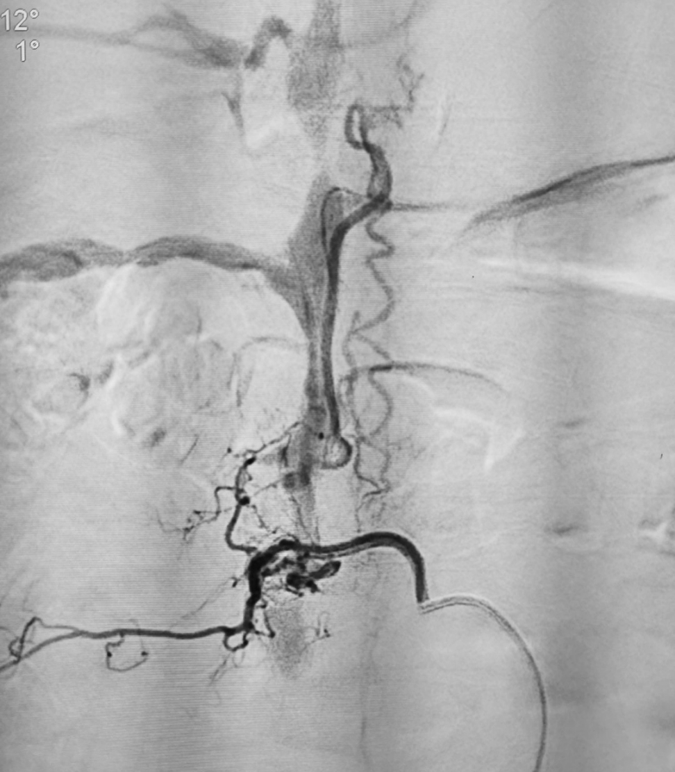 脊髓血管造影,见l1平面双侧根动脉供血高流量动静脉瘘,引流静脉位于
