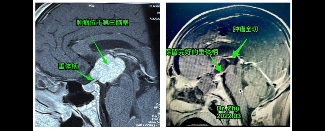 内镜经鼻蝶视交叉后型颅咽管瘤全切、垂体柄完整保留。