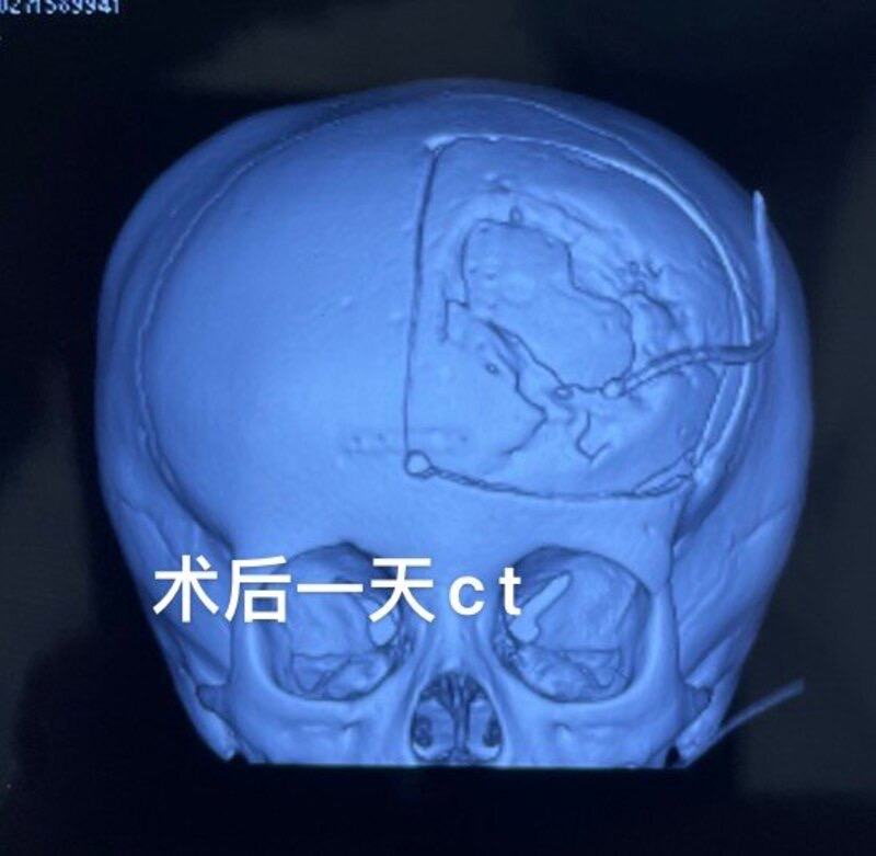 一例3岁3月小孩生长性颅骨骨折治疗