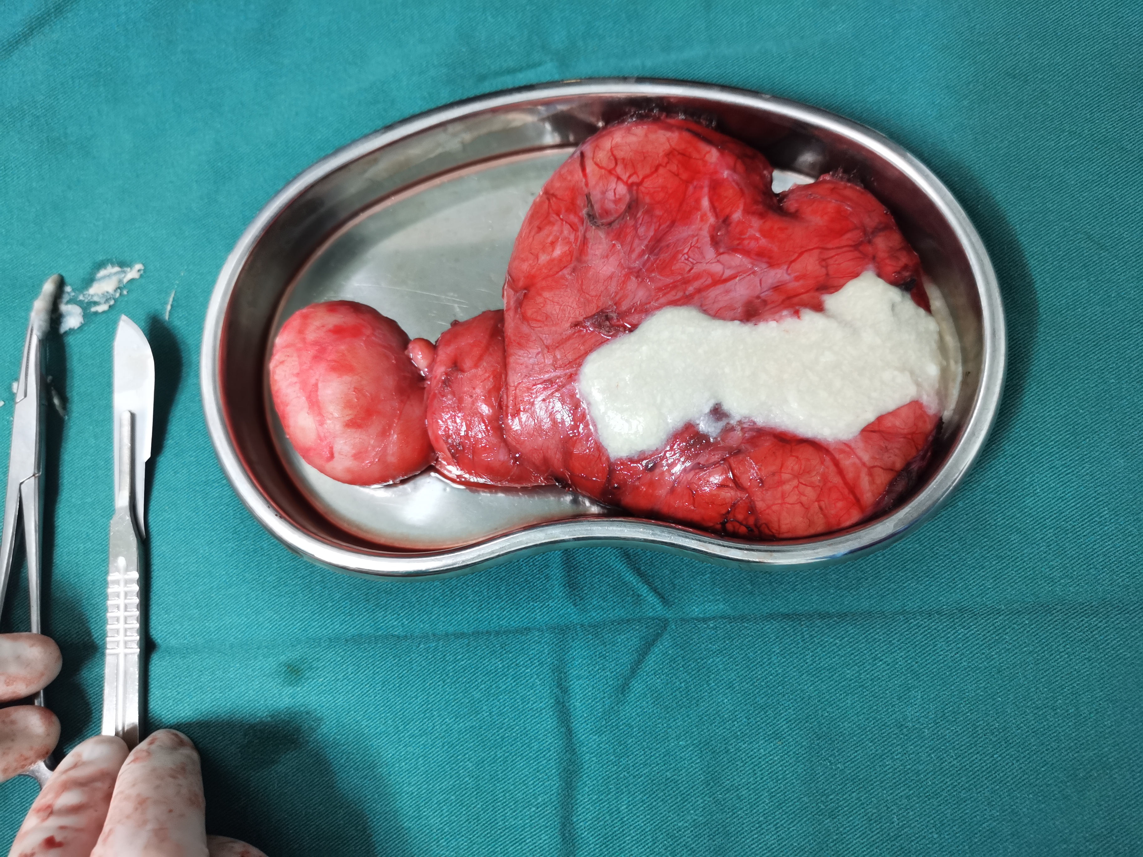 多学科合作手术切除巨大骶尾部表皮样囊肿一例 - 脑医汇 - 神外资讯