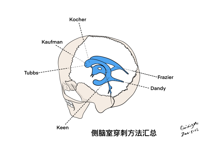 侧脑室穿刺术的手绘展示 - 脑医汇