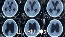 12岁男童，学习班级成绩第一☝️，头疼头晕2天，ct重度脑积水，观察？etv？后颅窝囊肿造瘘？
