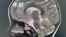 小儿Chiari畸形（小脑扁桃体下疝）合并脊髓空洞术中结合B超实时手术。