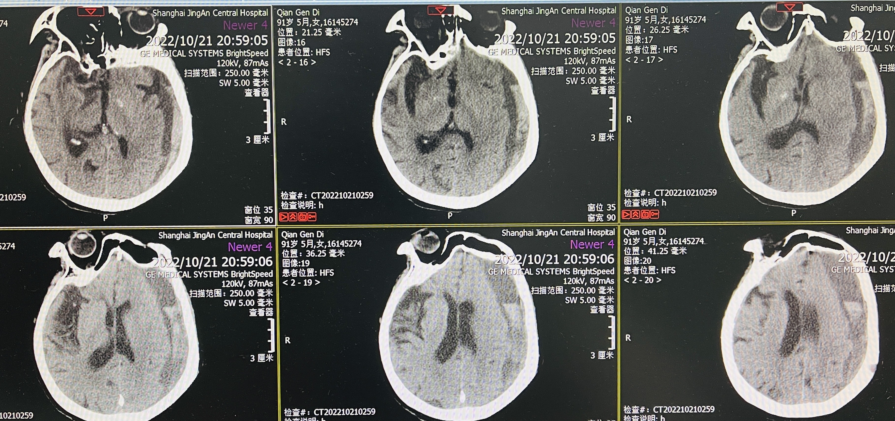 硬膜下积液图片