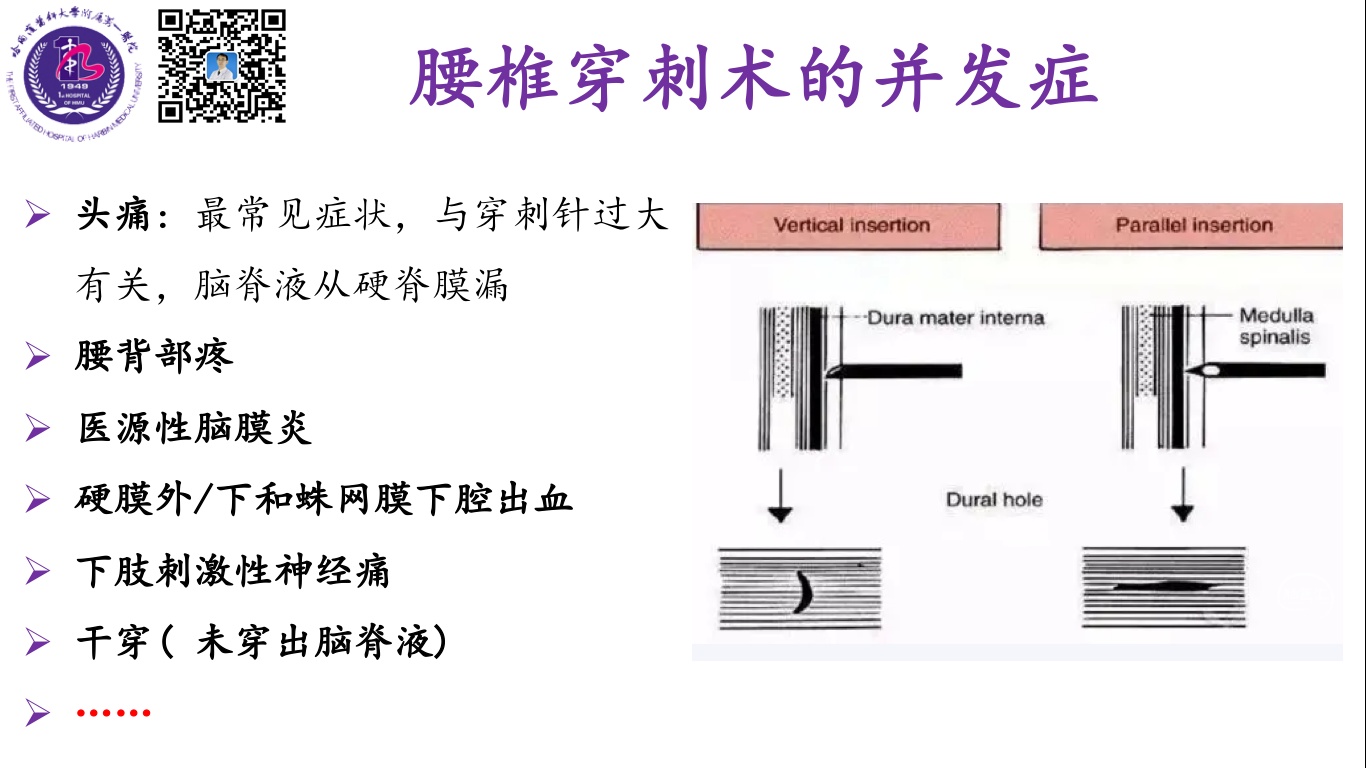 获得性椎管内表皮样囊肿-腰椎穿刺术后 - 脑医汇