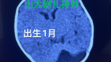2月大新生儿后颅窝蛛网膜囊肿合并颅裂畸形诊疗